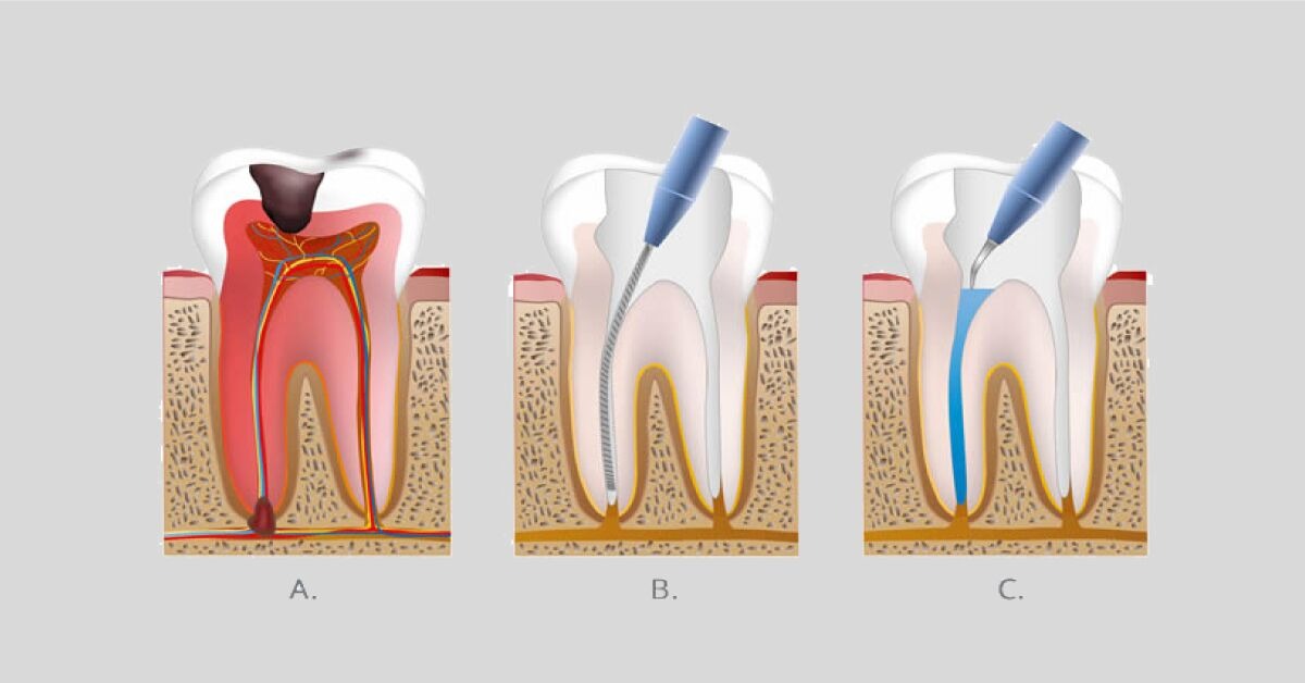 Painless Root Canal Treatments