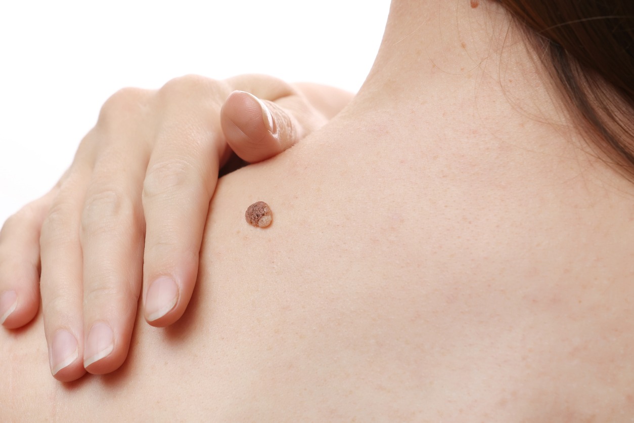 Skin Tag and Mole Removal