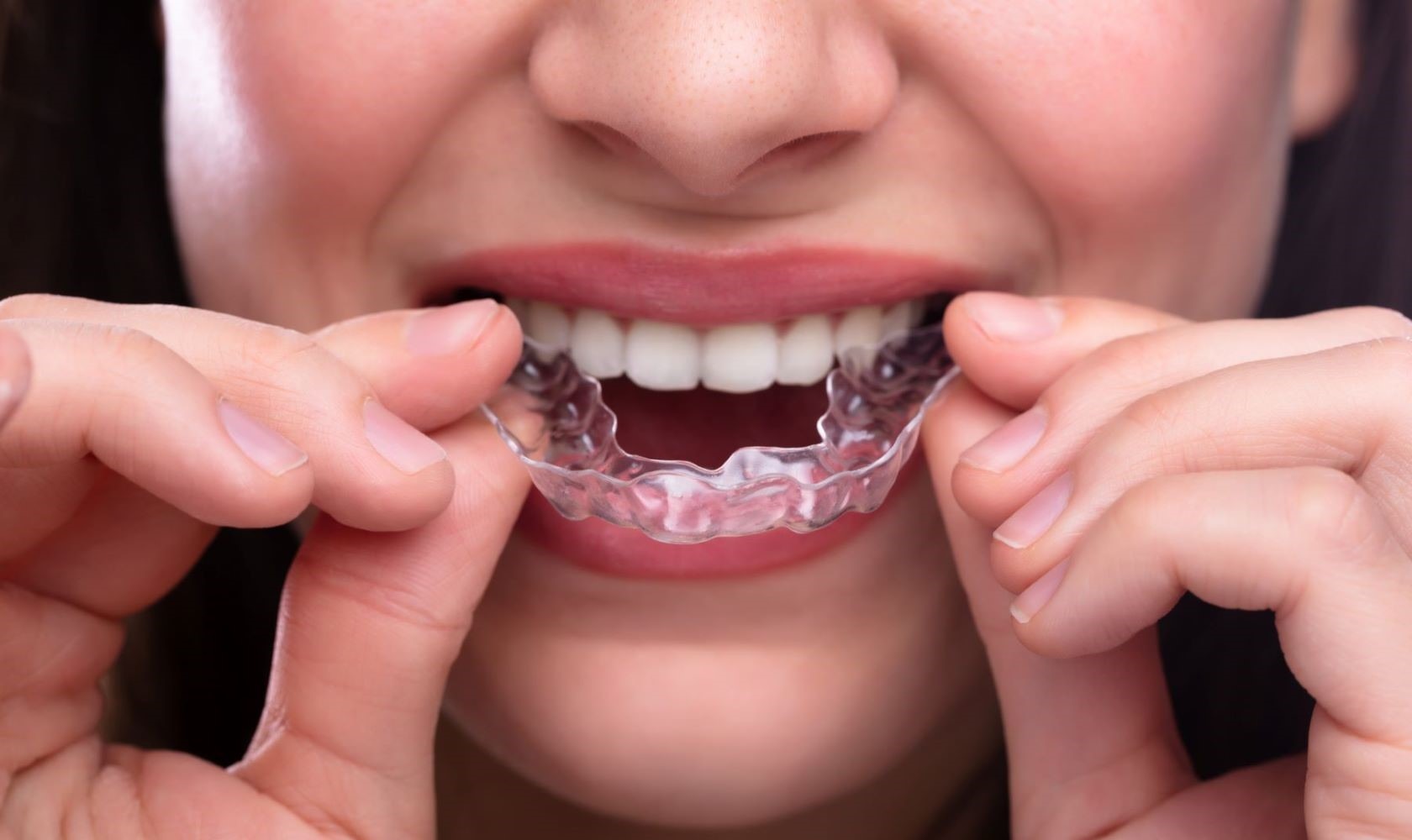 Invisalign Clear Aligners